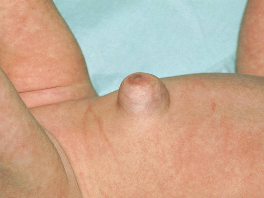 congenital-umbilical-hernia_4x3.jpg