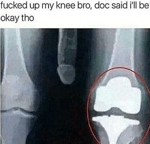 fucked up knee.jpg