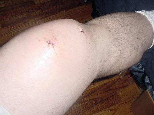 Knee2-vi.jpg